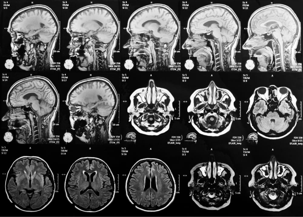 頭部MRI