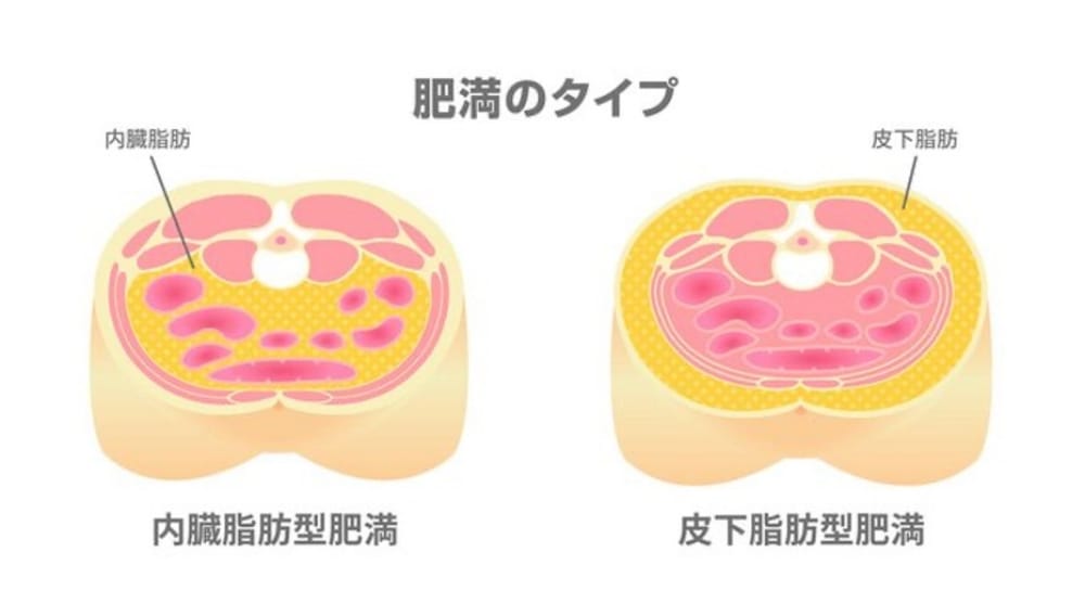 肥満のタイプ